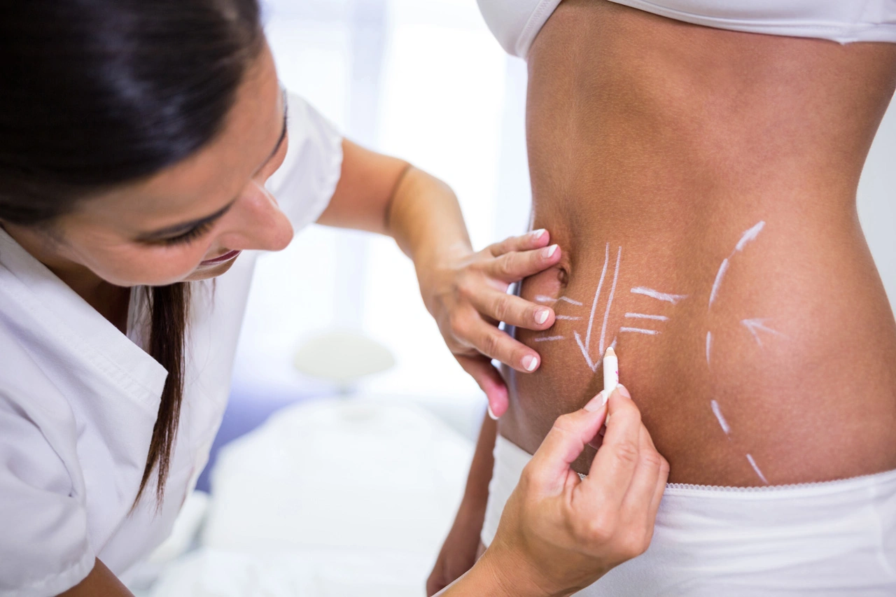 plastik cerrahi - Liposuction